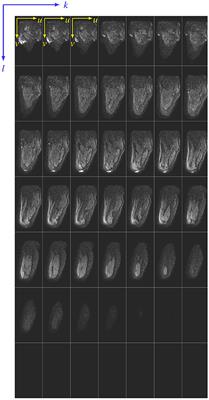 An Efficient Modelling-Simulation-Analysis Workflow to Investigate Stump-Socket Interaction Using Patient-Specific, Three-Dimensional, Continuum-Mechanical, Finite Element Residual Limb Models